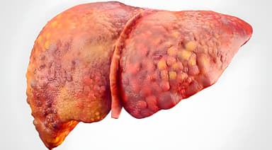 Cirrosis Hepática