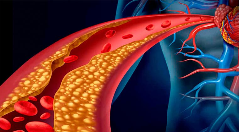 Dislipidemia