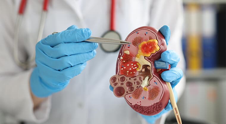 Insuficiencia Renal Crónica