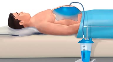 Paracentesis