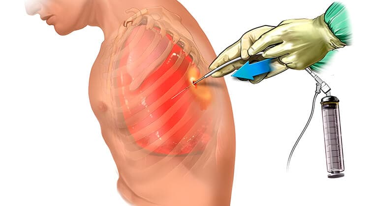 Toracocentesis